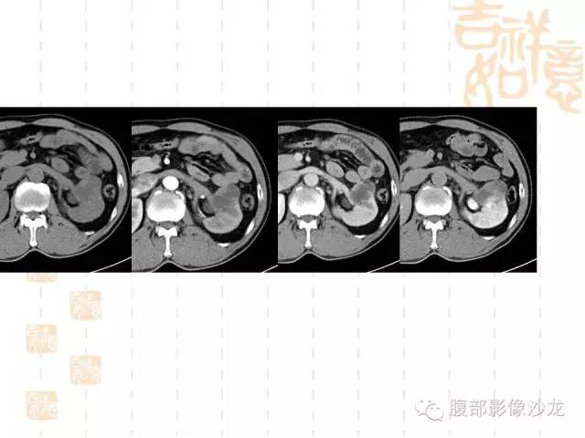 【PPT】肾囊实性病变分析 【PPT】肾囊实性病变分析