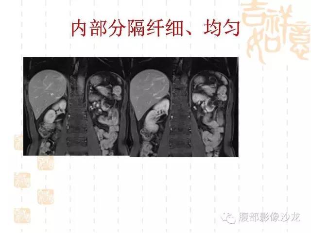 【PPT】肾囊实性病变分析 【PPT】肾囊实性病变分析