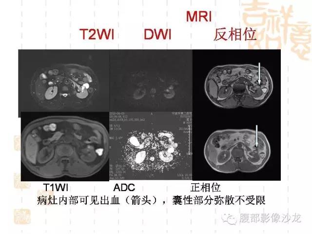 【PPT】肾囊实性病变分析 【PPT】肾囊实性病变分析