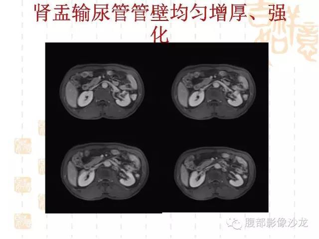 【PPT】肾囊实性病变分析 【PPT】肾囊实性病变分析