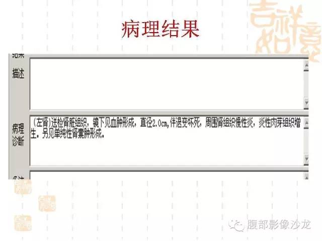 【PPT】肾囊实性病变分析 【PPT】肾囊实性病变分析