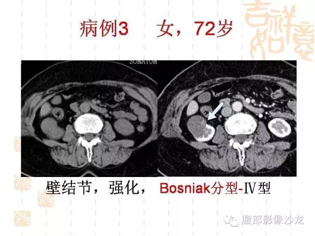 【PPT】肾囊实性病变分析 【PPT】肾囊实性病变分析