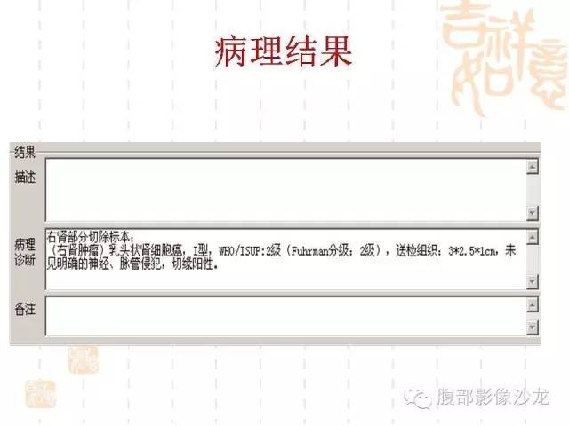 【PPT】肾囊实性病变分析 【PPT】肾囊实性病变分析
