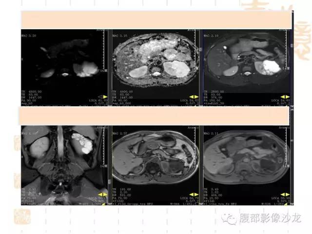【PPT】肾囊实性病变分析 【PPT】肾囊实性病变分析