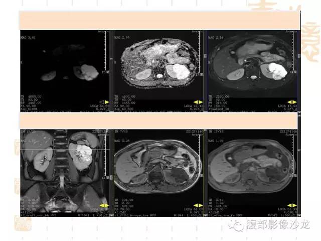 【PPT】肾囊实性病变分析 【PPT】肾囊实性病变分析