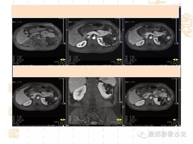 【PPT】肾囊实性病变分析 【PPT】肾囊实性病变分析