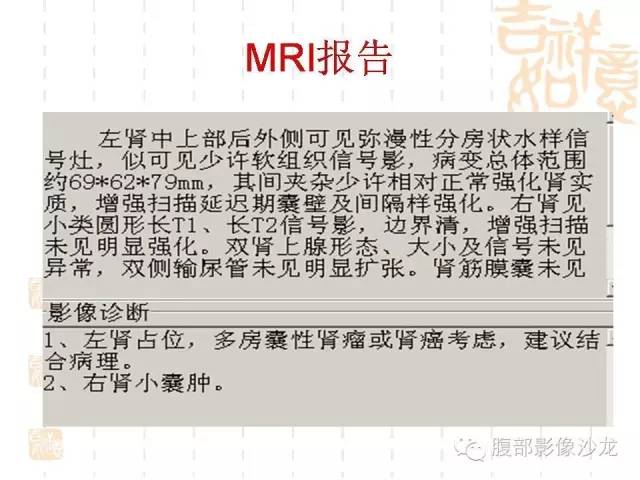 【PPT】肾囊实性病变分析 【PPT】肾囊实性病变分析