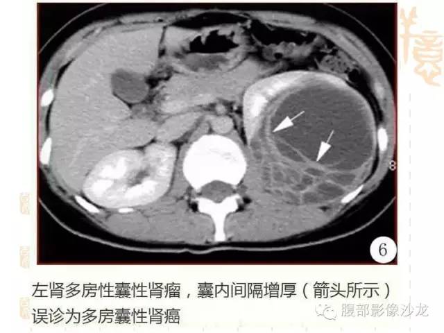 【PPT】肾囊实性病变分析 【PPT】肾囊实性病变分析