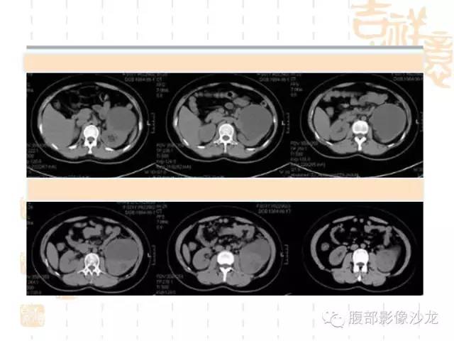 【PPT】肾囊实性病变分析 【PPT】肾囊实性病变分析