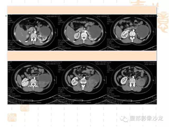 【PPT】肾囊实性病变分析 【PPT】肾囊实性病变分析