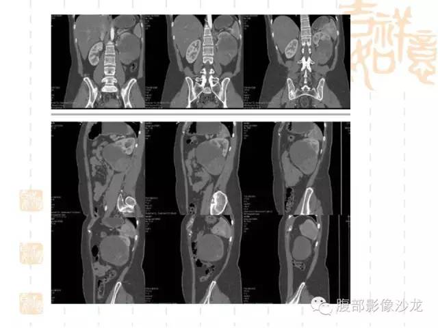 【PPT】肾囊实性病变分析 【PPT】肾囊实性病变分析