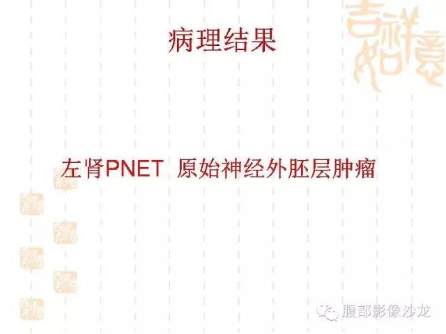【PPT】肾囊实性病变分析 【PPT】肾囊实性病变分析