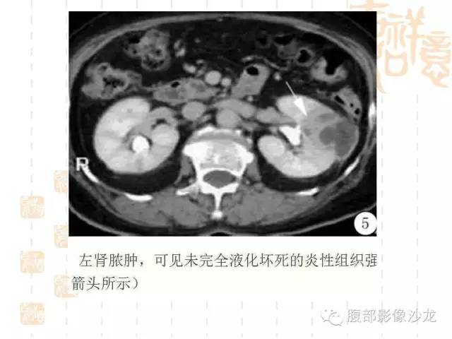 【PPT】肾囊实性病变分析 【PPT】肾囊实性病变分析