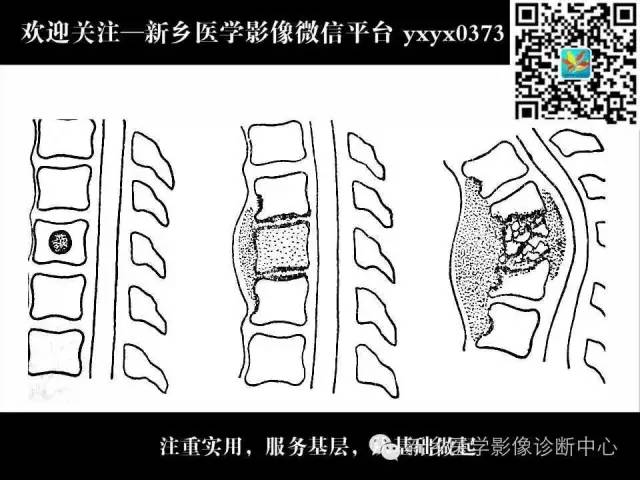 【PPT】脊柱结核影像分型和诊断