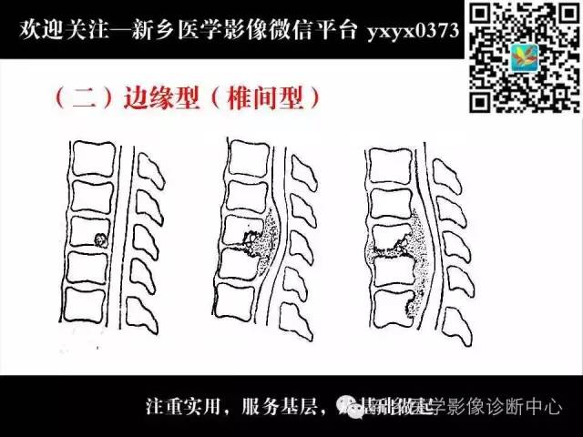 【PPT】脊柱结核影像分型和诊断