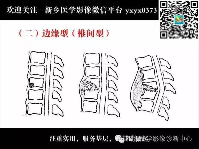 【PPT】脊柱结核影像分型和诊断