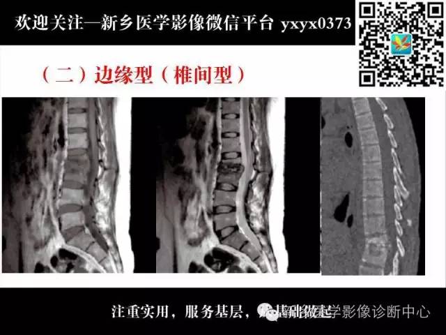 【PPT】脊柱结核影像分型和诊断
