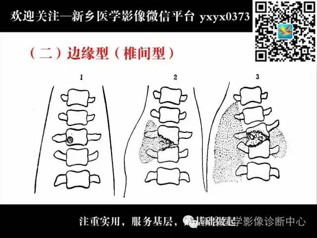 【PPT】脊柱结核影像分型和诊断
