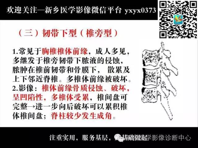 【PPT】脊柱结核影像分型和诊断