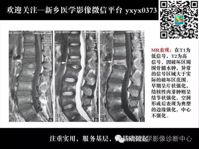 【PPT】脊柱结核影像分型和诊断