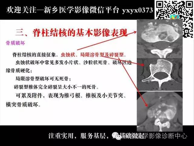【PPT】脊柱结核影像分型和诊断