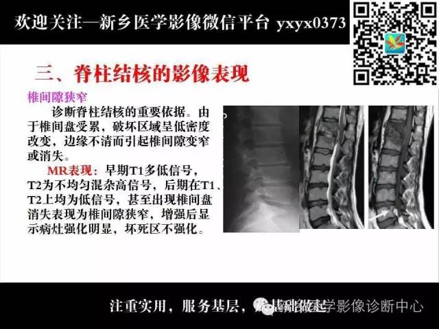 【PPT】脊柱结核影像分型和诊断