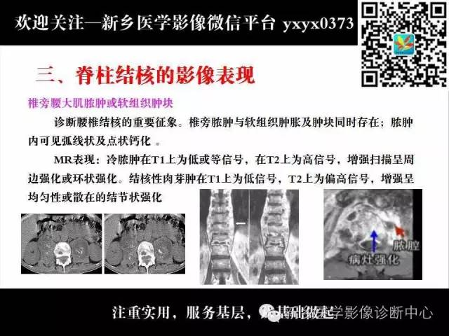 【PPT】脊柱结核影像分型和诊断