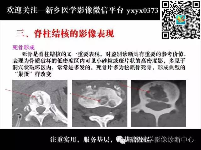 【PPT】脊柱结核影像分型和诊断