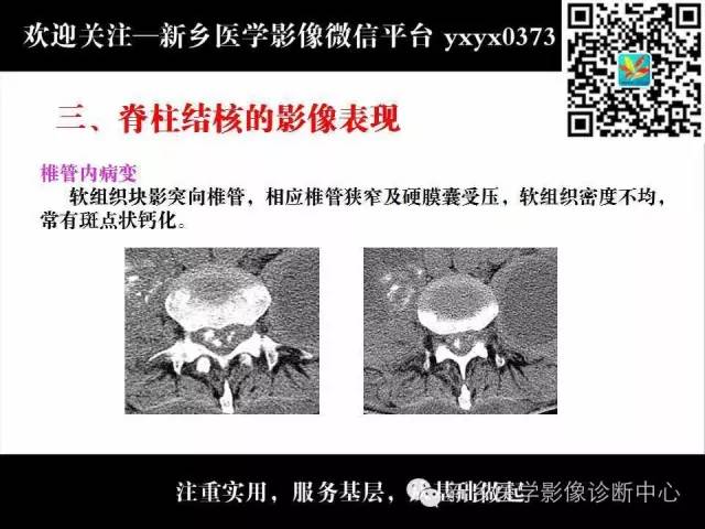 【PPT】脊柱结核影像分型和诊断