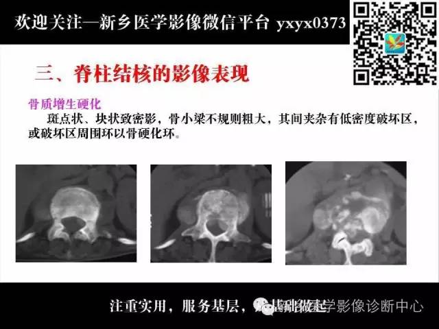 【PPT】脊柱结核影像分型和诊断