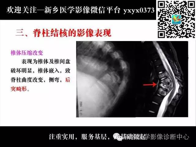 【PPT】脊柱结核影像分型和诊断