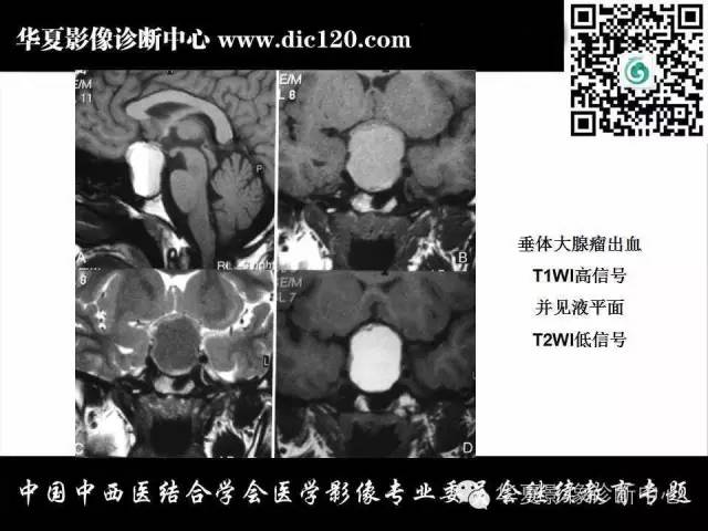 【PPT】鞍内常见病变的诊断