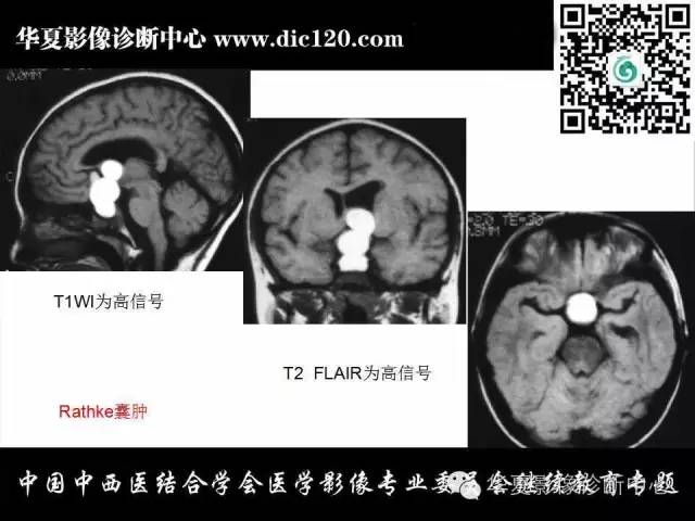 【PPT】鞍内常见病变的诊断