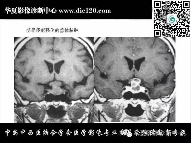 【PPT】鞍内常见病变的诊断
