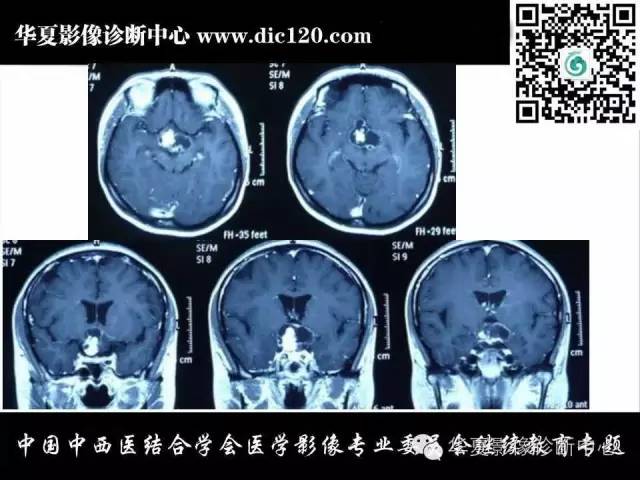 【PPT】鞍区周围常见病变的影像诊断