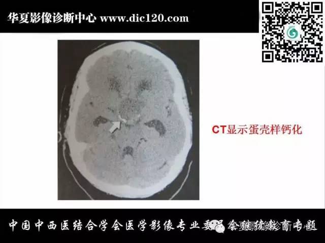 【PPT】鞍区周围常见病变的影像诊断