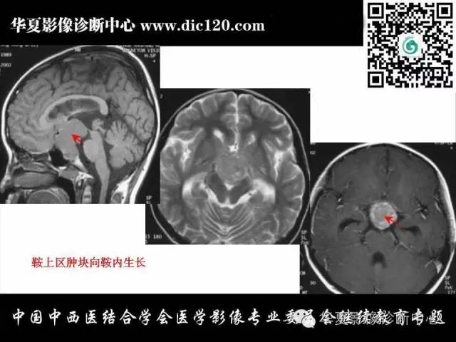 【PPT】鞍区周围常见病变的影像诊断