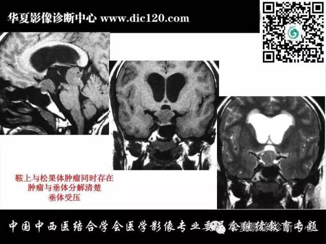 【PPT】鞍区周围常见病变的影像诊断