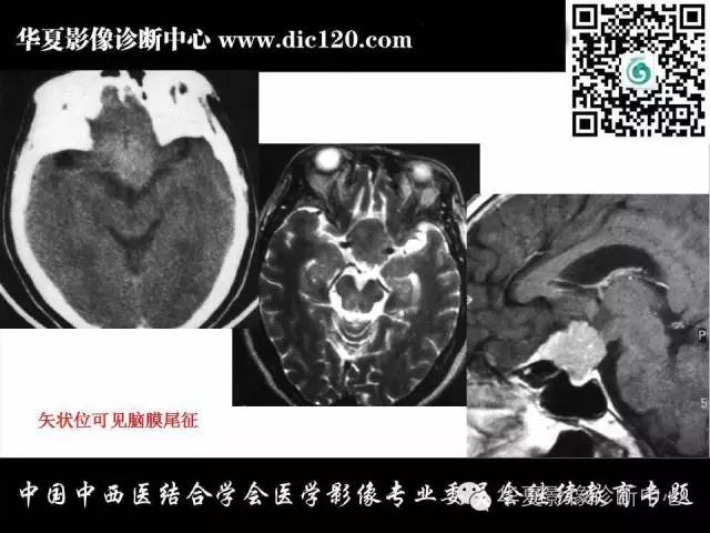 【PPT】鞍区周围常见病变的影像诊断