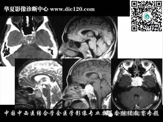 【PPT】鞍区周围常见病变的影像诊断