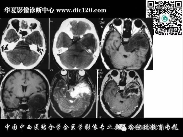 【PPT】鞍区周围常见病变的影像诊断
