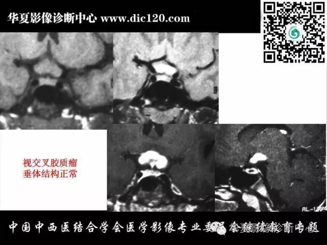 【PPT】鞍区周围常见病变的影像诊断