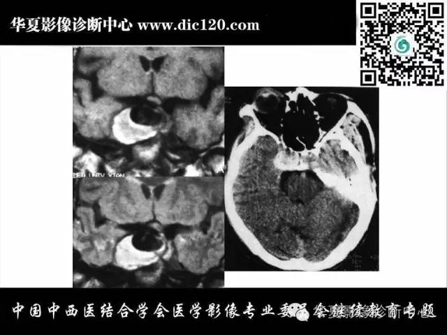 【PPT】鞍区周围常见病变的影像诊断