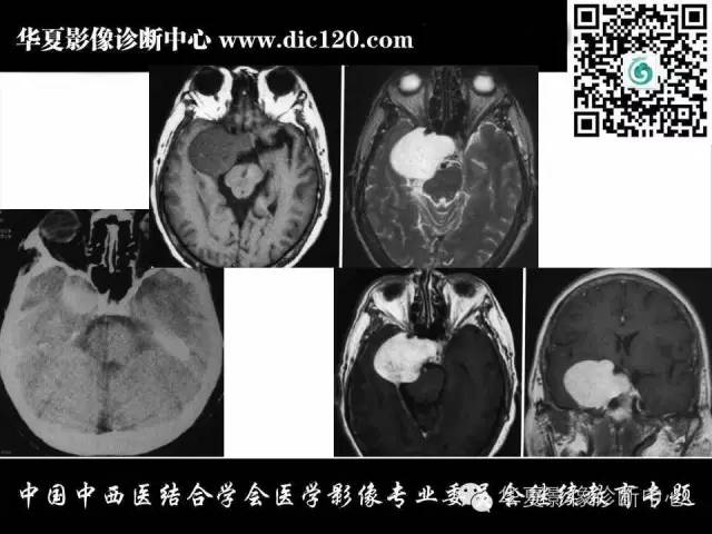 【PPT】鞍区周围常见病变的影像诊断