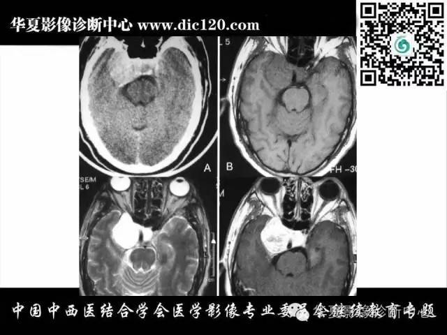 【PPT】鞍区周围常见病变的影像诊断