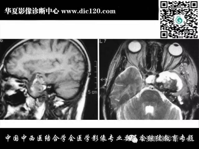 【PPT】鞍区周围常见病变的影像诊断