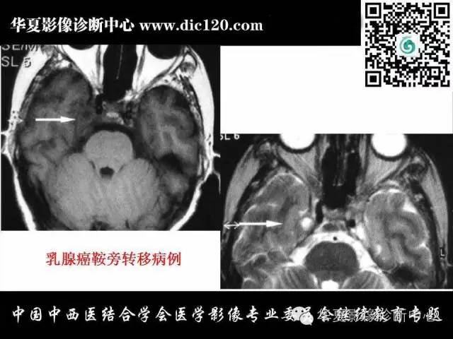 【PPT】鞍区周围常见病变的影像诊断