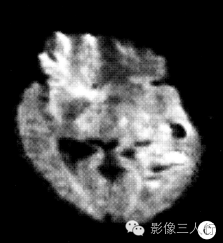 【病例】左颞枕叶间变性少突-星形细胞瘤1例MR影像表现