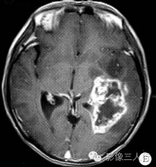 【病例】左颞枕叶间变性少突-星形细胞瘤1例MR影像表现