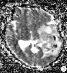 【病例】左颞枕叶间变性少突-星形细胞瘤1例MR影像表现